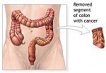 Colon with Colorectal Cancer