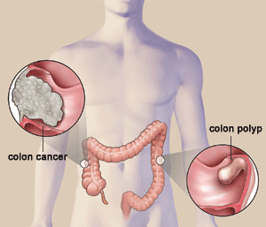 Prevention of Colon Cancer and Polyps.
