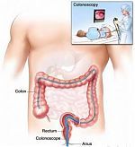 Colon Cleansing In Preparation For A Colonoscopy.