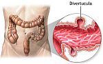 Diverticula Causes and Treatments.