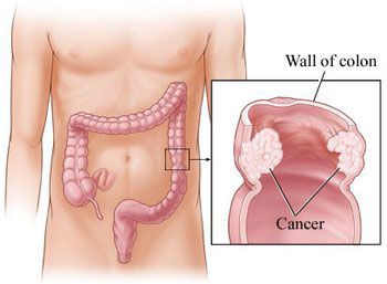 Causes and Prevention of Colon cancer, or colorectal cancer.