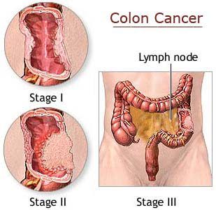 Colon Rectal Cancer Stages.
