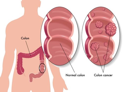 Normal colon, colon cancer