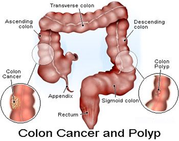 Colon Cancer and Polyp