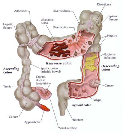 An Unhealthy Colon: Causes, Symptoms and Treatment. Information about the diseases and disorders of the large intestine or colon.