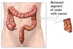 Area of colon with cancer