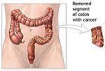 Area of colon with cancer