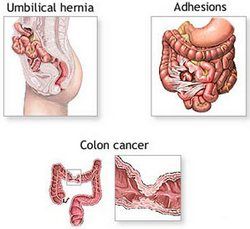 Unhealthy Colon - Diseases and Disorders